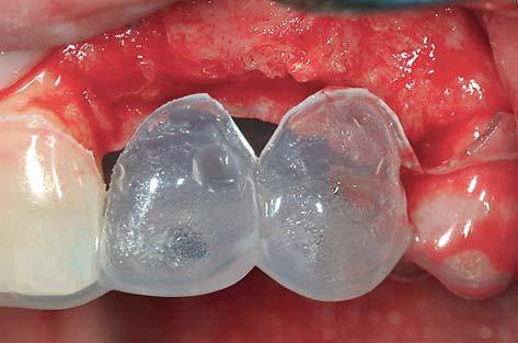 as most patients in this category are interested primarily in a pleasing esthetic outcome, the esthetic risk is almost always increased; these cases should be considered complex, irrespective of the