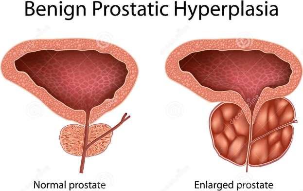 Benign Prostatic Hyperplasia (BPH) Definition Prostate gland enlargement is a common condition as men get older.