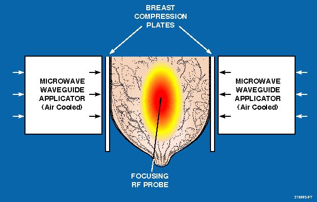APA 1000 Breast Cancer System Phase III An RF needle probe inserted at tumor center provides feed-back signal to focus microwave energy at tumor center to induce shrinkage