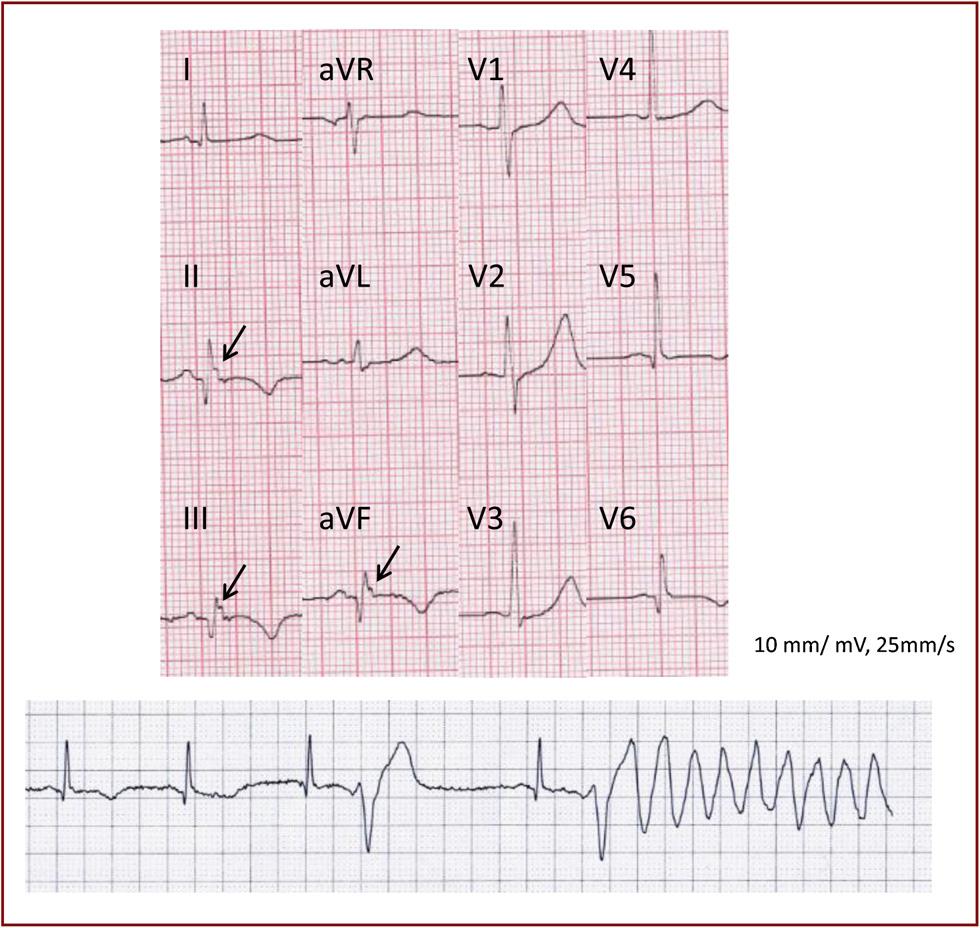 J waves in ACS patients with ventricular fibrillation 581 Figure 2. Ventricular fibrillation (VF) in a patient with J waves.
