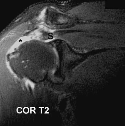 54 RadCases Musculoskeletal Radiology Imaging Findings (,) Coronal images of the shoulder demonstrate complete discontinuity of the supraspinatus tendon (S).