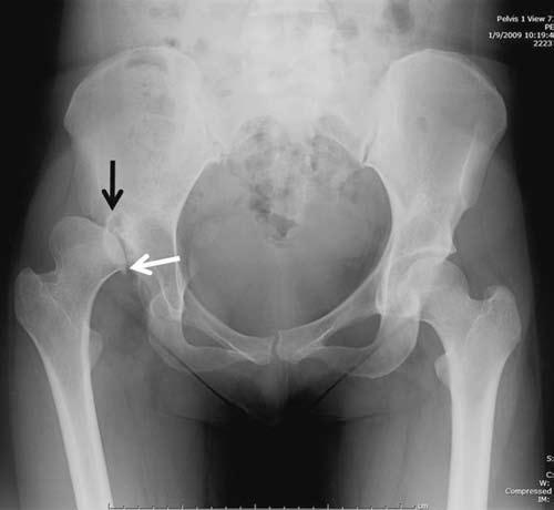 196 RadCases Musculoskeletal Radiology Imaging Findings (,) Radiographs of the pelvis and right hip show a hypoplastic/dysplastic-appearing lateral acetabular roof containing sclerosis and cystic