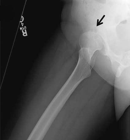 Differential Diagnosis Developmental hip dysplasia: Unilateral superior subluxation of the hip secondary to an underdeveloped acetabulum is representative of developmental hip dysplasia.