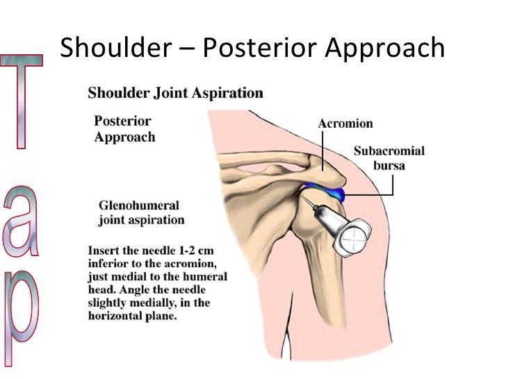 Posterior approach