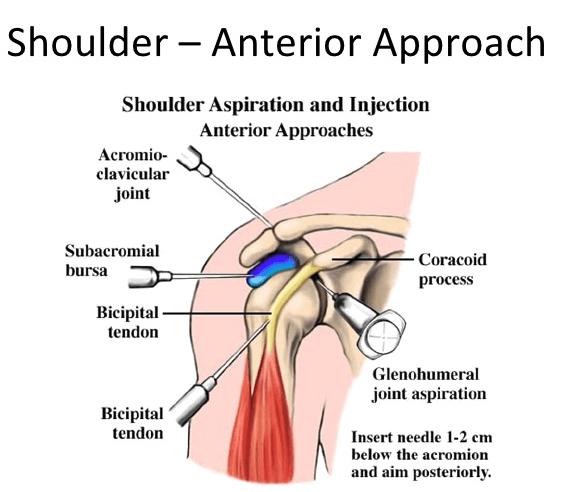 Anterior injection approaches Subacromial