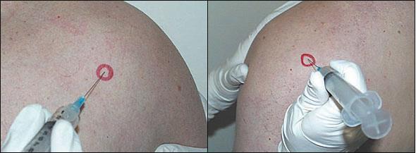 Subacromial Injection Recommend 22-25G needle, minimum 1 ½ Patient sitting with