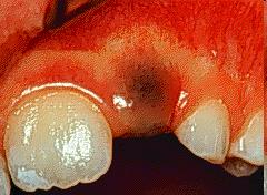 ERUPTION: the movement of the developing tooth in axial direction from its original location in the jaw bone to its functional position in the oral cavity Eruption Cyst is a bluish, translucent,