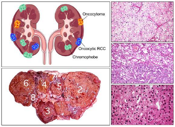 Chromophobe Chromophobe + oncocytic Mixed pattern Bilateral.