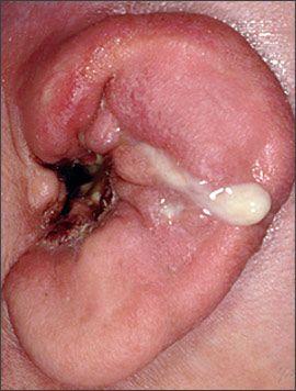Otitis Externa: Dermatitis of epithelium of outer ear - Irritated inflamed tissues of outer ear and ear canal - Possible in all ages - Can cause severe