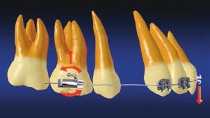 Hence, the molar tube in the classic Straight-Wire ppliance, based on ndrews s six keys to normal occlusion, 8 has a prescription of +5.