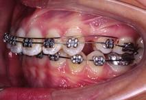 With small initial archwire in MLF bracket, ligature is held in constricted cervical area, avoiding