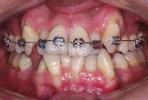 The PSS technique avoids the need for mechanical anchorage reinforcement by taking advantage of the patient s physiological anchorage, while the pretreatment molar positions are maintained during
