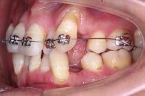 2 in the group treated with headgear 3 ; therefore, keeping the upper first molar upright with the 7 XT tube would save about 2mm of anchorage nearly one-third of the premolar-extraction space in a