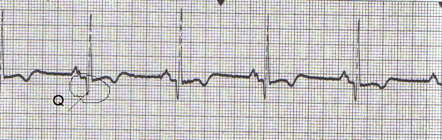 Infarction Necrosis Dead tissue Q waves present When seen with elevated ST segments it