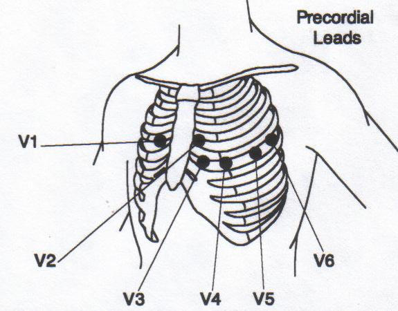 Between V4 and V2 V4-5 th IC space midclavicular