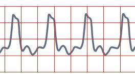 Missing a round upright P wave Rate usually between