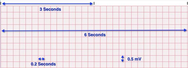 ECG GRAPH PAPER ECG Machine Calibration 1 mv tall (2 boxes) Remember: * Paper speed is 25 mm/sec * 1 little box
