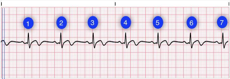 FINDING THE RATE Count the number of QRS