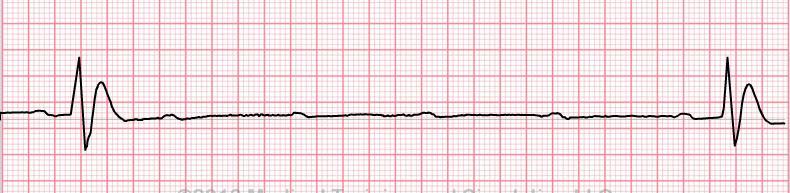 COMPLETE HEART BLOCK 3 RD DEGREE None of the atrial impulses get though the AV node.