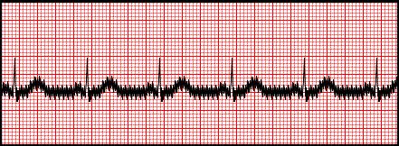 TECHNICAL PROBLEMS 60 Hz AC - Electrical interference ECG