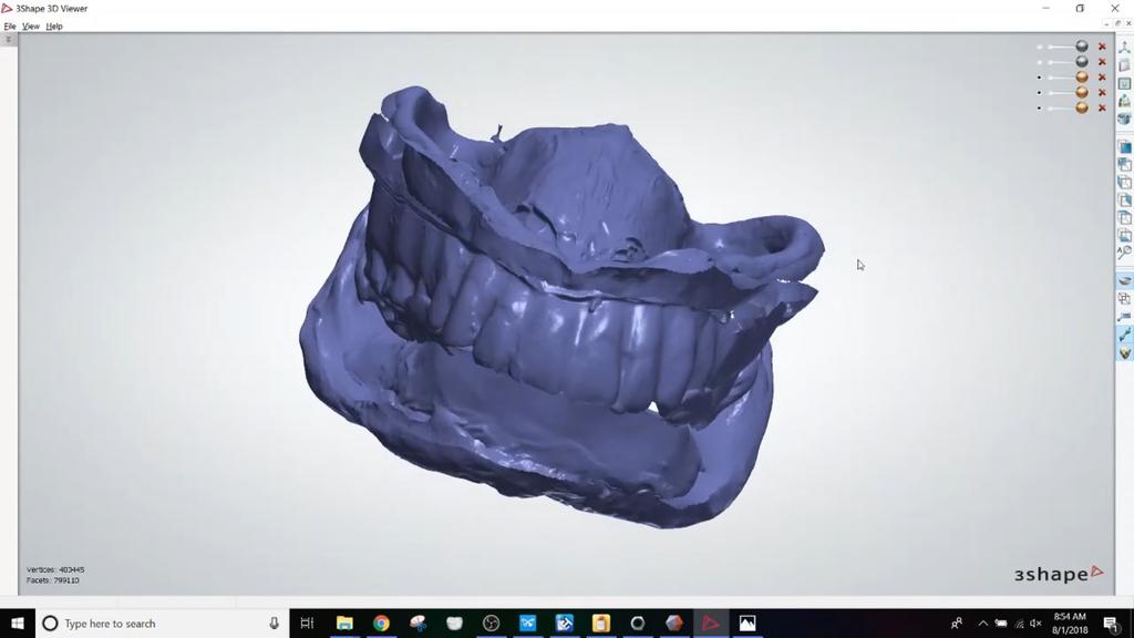 Her mandibular arch was severely resorbed with poor prognosis for a complete denture. Her existing maxillary denture was found to have poor tooth position and required replacement.