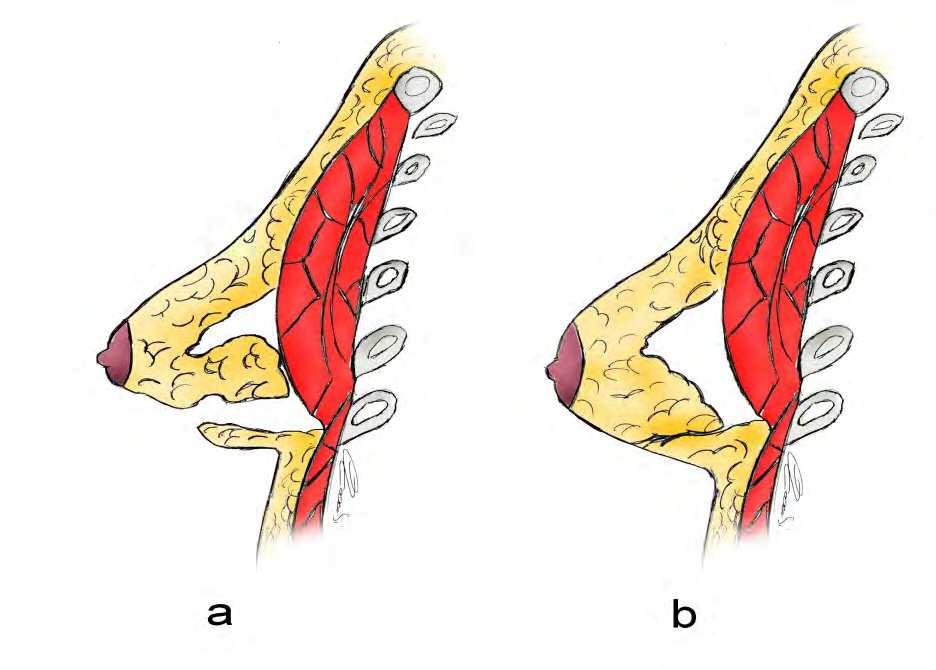 Tuberous Breast: Clinical Evaluation and Surgical Treatment 143 Fig. 10. Puckett technique: a: glandular flap elevation, b: final position of flap.