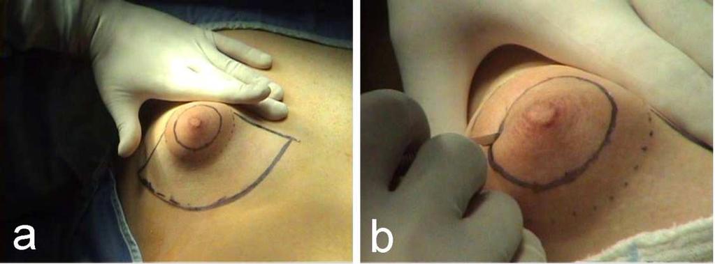 Tuberous Breast: Clinical Evaluation and Surgical Treatment 145 The areola outer border and neo-inframamamry fold are then marked, fig. 13a. The new areolar margin is incised by a scalpel, fig.