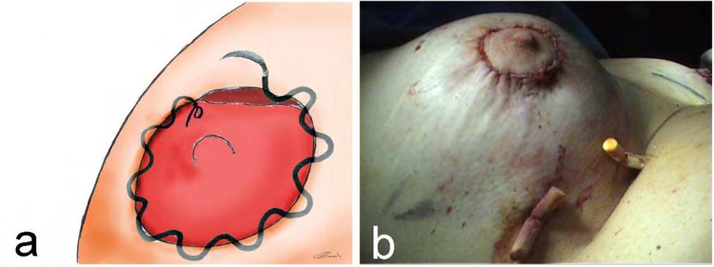closed using a continue suture with the cutaneous portion that pass through the dermis and the areolar run on the tissue
