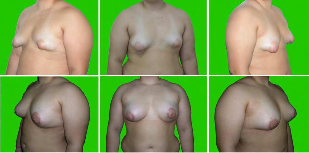 Tuberous Breast: Clinical Evaluation and Surgical Treatment 149 8. Results With a minimum follow-up of 6 month we obtain the complete remission in all patients.