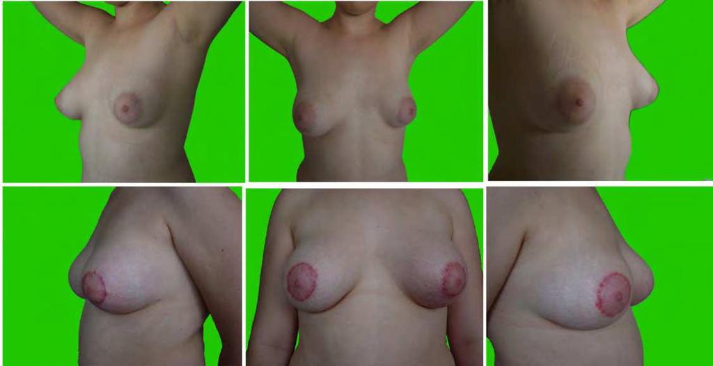 150 Current Concepts in Plastic Surgery 9.2 Case report no. 2. Fig. 22. Fig. 22. G.S. 18years-old girl with left tuberous breast type II with low asymmetry.