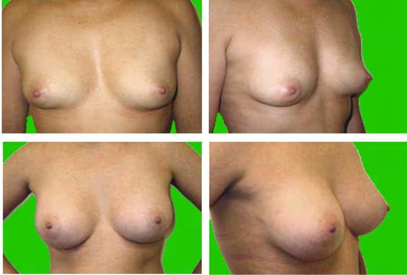 Tuberous Breast: Clinical Evaluation and Surgical Treatment 151 few amount of glandular parenchyma, an implant under the muscle was positioned (230cc) and in