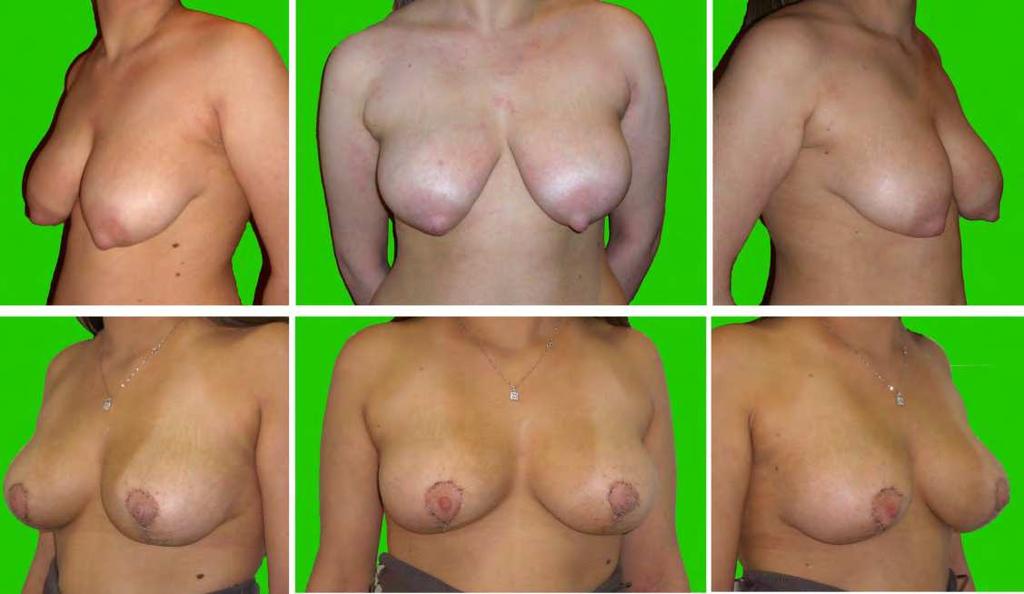 - 25yars-holg girl with bilateral tuberous breast Type II. We have a reconstruction performing Puckett technique and retroglandular implant (R=L:190cc). 9.