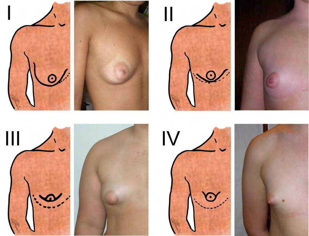 Tuberous Breast: Clinical Evaluation and Surgical Treatment 137 3. Classifications Several classification schemes for tuberous breast have been proposed.
