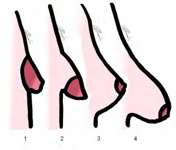 Tuberous Breast: Clinical Evaluation and Surgical Treatment 139 Fig. 5. Differential diagnosis: 1. Tuberous breast, 2. Tubular breast, 3. Normal breast, 4.Ptotic breast. 5. Treatment Surgery is the only way to treat tuberous breast.