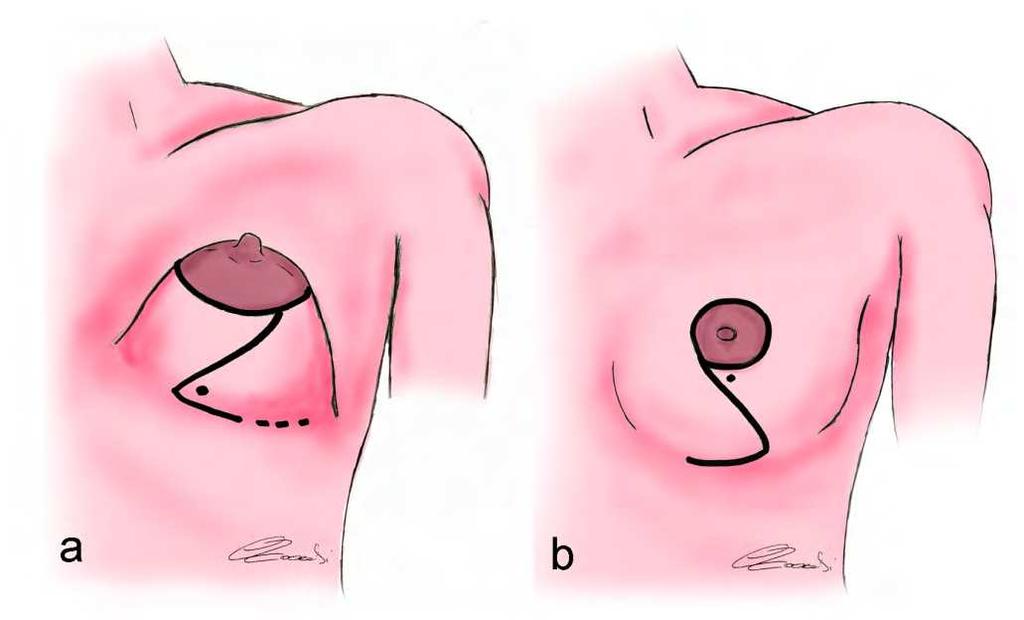 Tuberous Breast: Clinical Evaluation and Surgical Treatment 141 Fig. 7. Millard Z-plasty a: preoperative planning; b: result. 6.