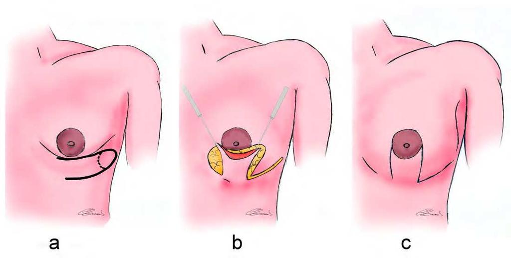 The flap is based medially with its blood supply from the lateral branches of the superior epigastric artery.