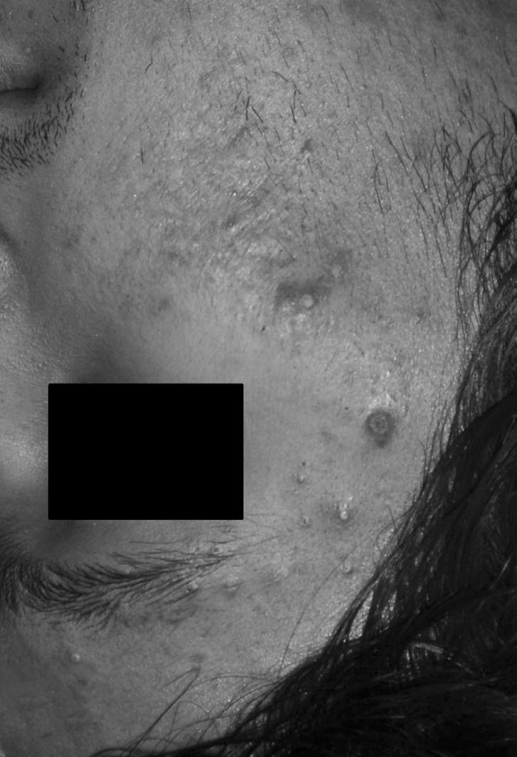 Photos were taken at () baseline and () two months after treatment. Fig. 4.