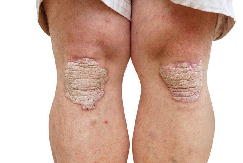 Psoriasis is a common skin condition that speeds up the life cycle of skin cells.