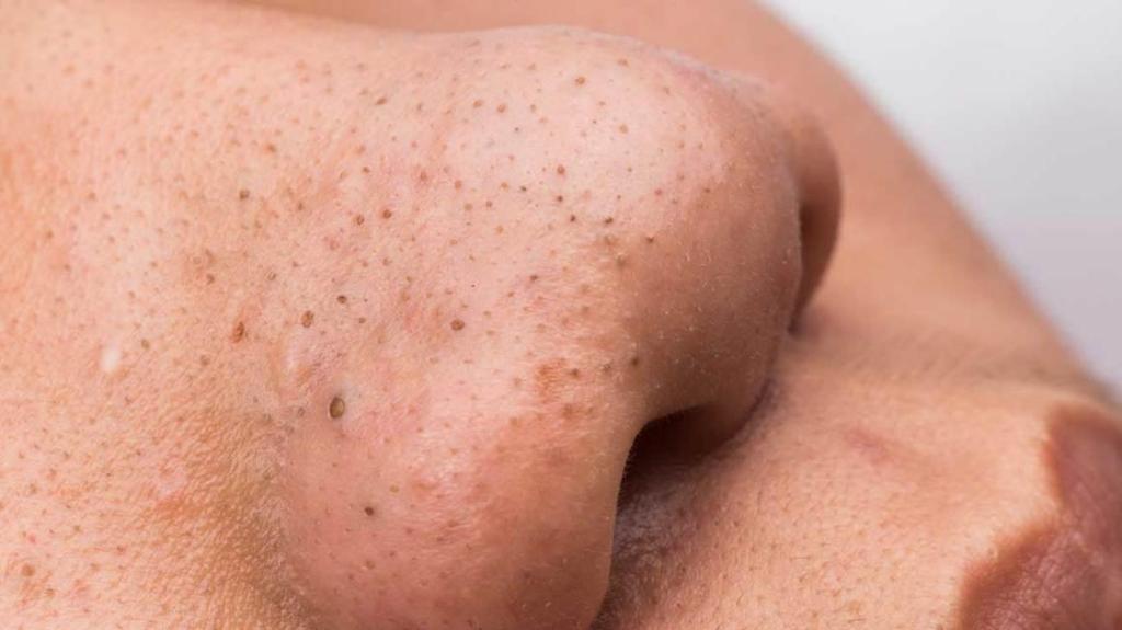 follicle (pore) in the skin.