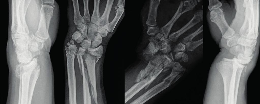 TOPICS Carpal Disorders Distal Radius Fracture Dru-Joint and