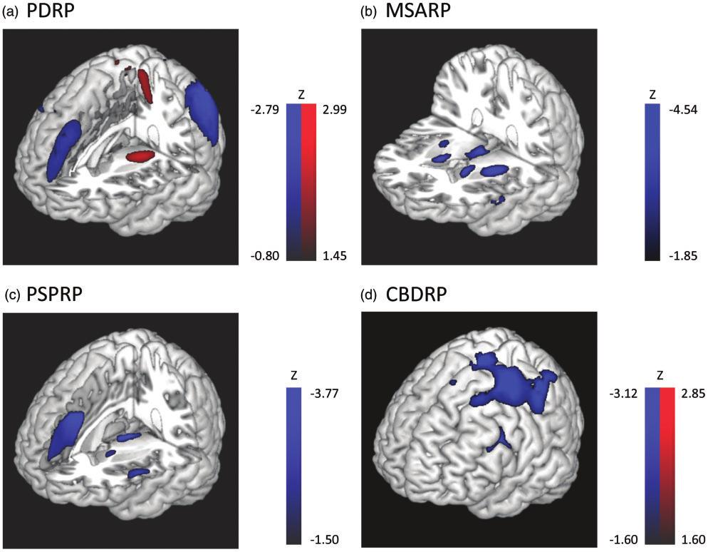 684 Journal of Cerebral Blood Flow & Metabolism 37(2) from one another by distinct disease-related metabolic network topographies.