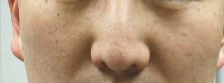 Anatomy: Nasal Valve y Upper lateral