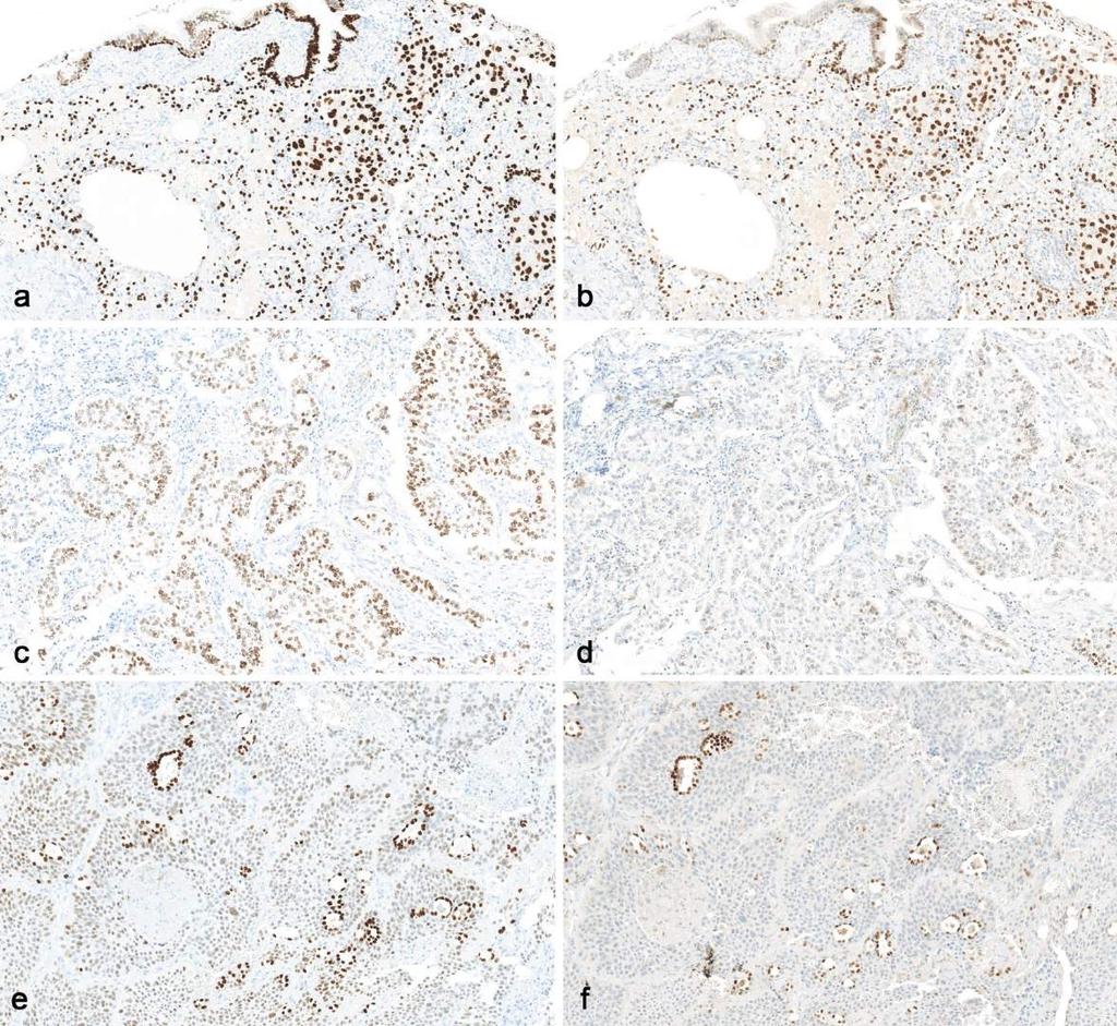Lung squamous cell carcinoma SPT24,