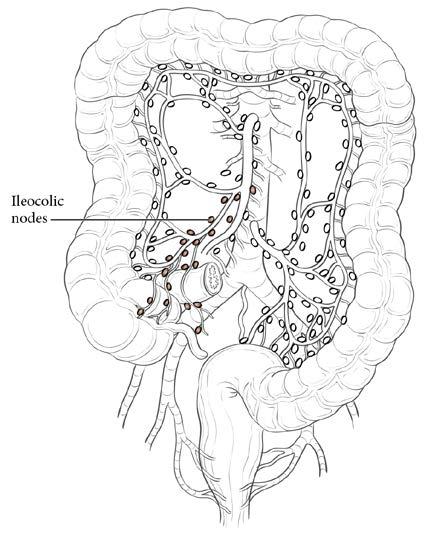 19. Appendix - Carcinoma 9 Anatomy FIGURE 19.1. Anatomic location of the appendix FIGURE 19.