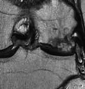 implantation Total knee