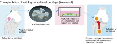 Methods: Atelocollagen-associated ACI procedure 2-stage procedure 1)2)3) 1 Cartilage harvest from unloaded area of