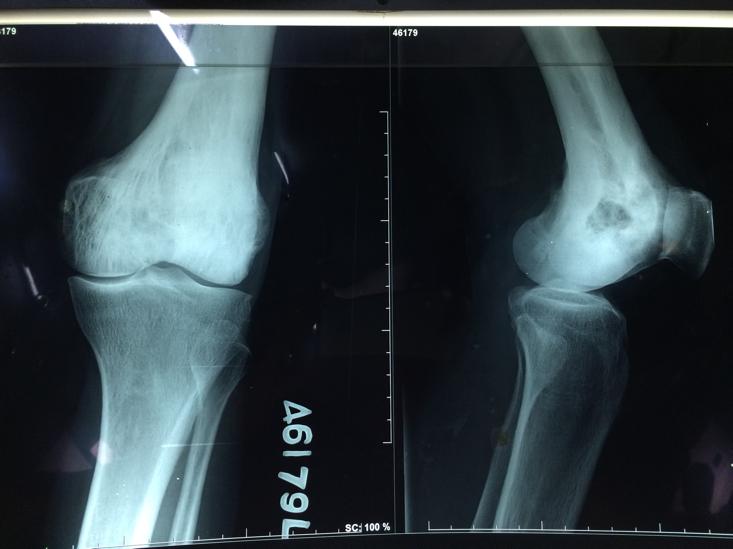 X-ray knee joint