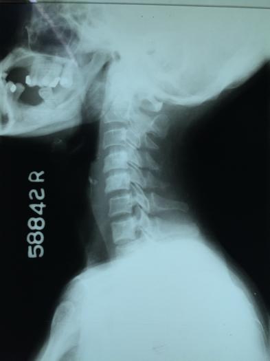 X-ray cervical spine - lateral