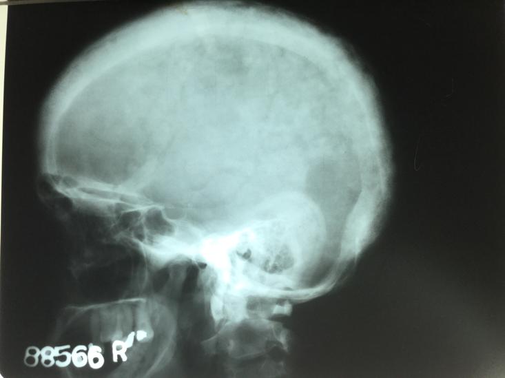 Skull x-ray -