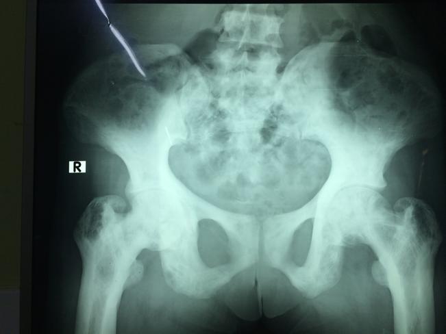 X-ray pelvis - lytic and